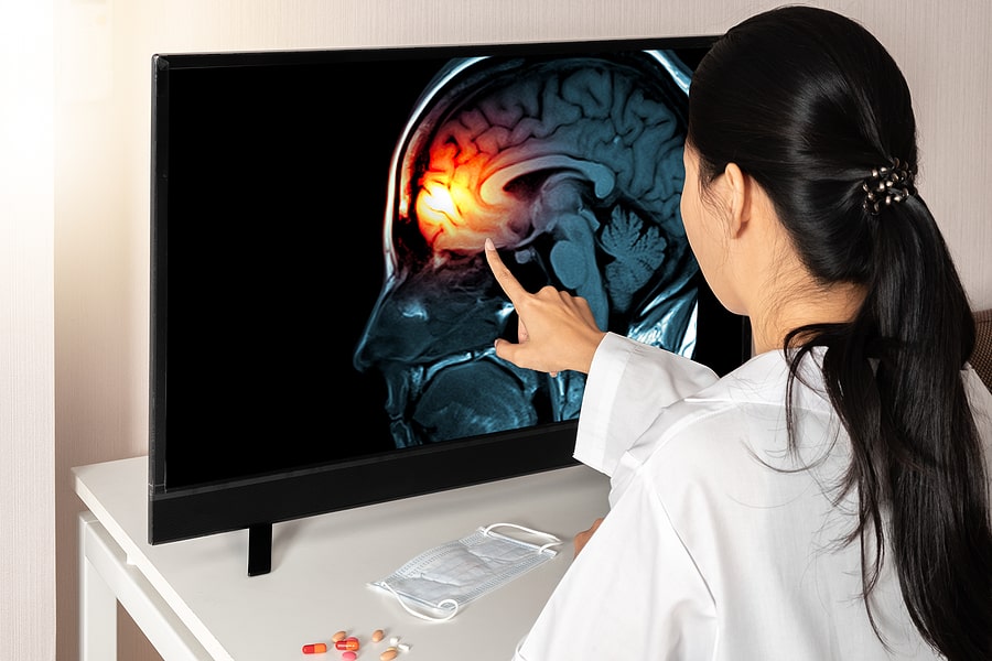 brain Stem Injury can cost millions